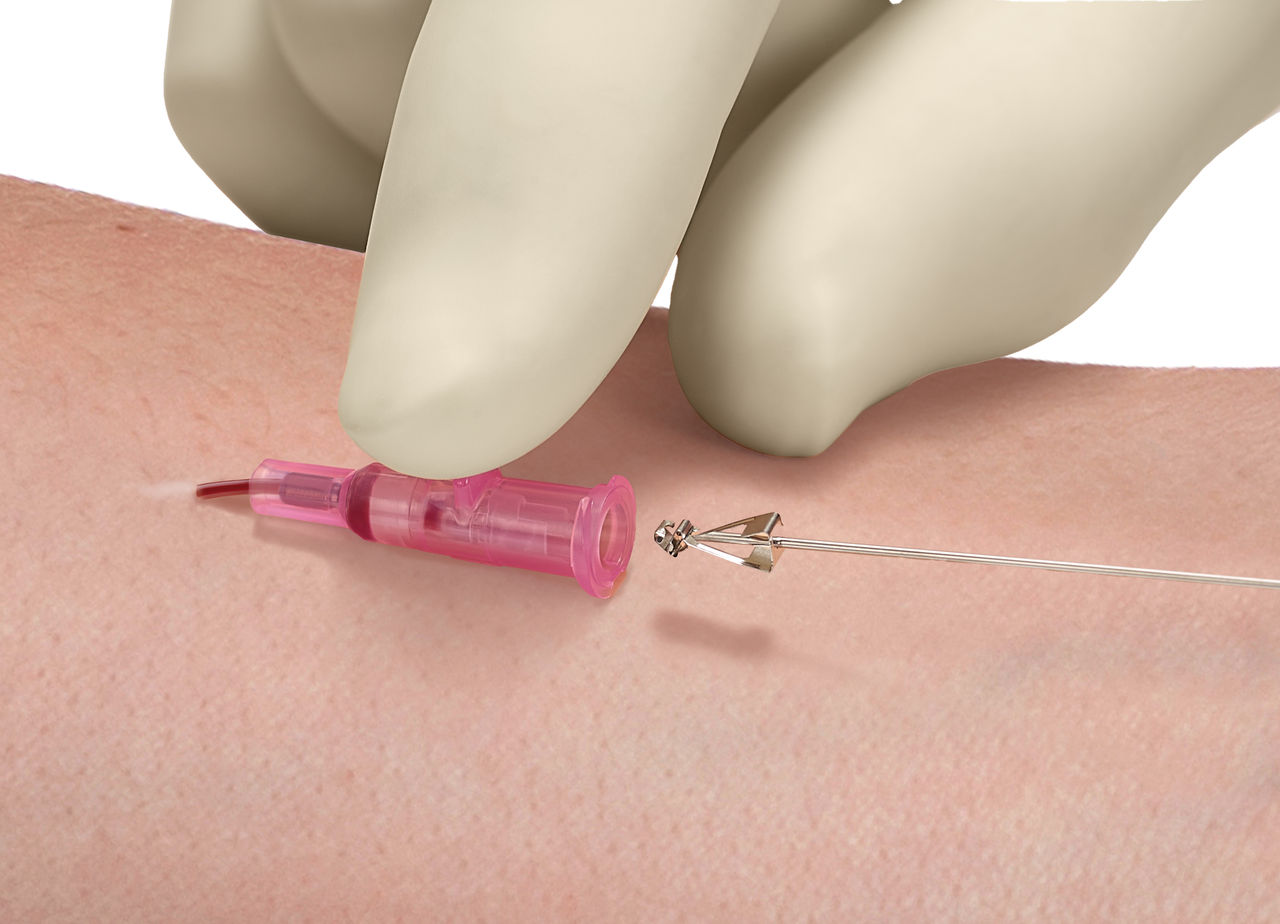Introcan Safety Peripheral IV Catheter held by two gloved fingers as it is inserted into a patient's arm at a straight angle.